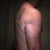 1 day after Vaser Hi-Def to my arms