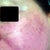 Day 6 treatment 2