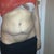 Front on view with bottom bulging and fat deposits, extra skin still
1 year post op here
