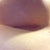 Incision on left 3 weeks post op...looks lighter than in picture! Healed up and the scar is now thinning :))