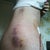 Bruising from lipo. 3 days po