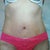 3 wks po.  One more wk and I can uncover the scar.
