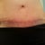 4 weeks po (flakes are dried up Mederma)