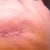 Stitches under my chin removed.