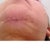 My chin incision AFTER two weeks