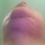 Chin scar post of six week