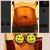 Side by side comparison. Pre-op vs 3 wks post op