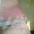 POD9, left hip, not too good, big bulge where bruise is above incision and dent below, revision possible I'm thinking.
