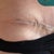 4 weeks PO left side, ledge/bulge side