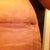 15 Days PO,  small indention where the left drain was removed a week ago.  Hoping this is still just swollen.  Only time will tell.