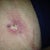 Infection of one of the Lipo Incision sites, under my left butt cheek.  PS prescribed some antibiotics for a few days  (17 days PO )