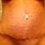 17 Days PO.   I don't like that my hips look uneven, hoping this is swelling and will go down in time.