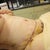 Day 5 - post op - side view