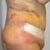 post op day 4 side