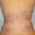 post op day 4 back