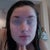 My face during the 6th week. A couple pimples but nothing severe. Red marks still present but not terrible, hopefully they're in the process of fading. Satisfied thus far that the worst is over.