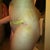 PO Day 5 - Lipo bruises
