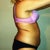 pre- op 2wks