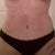 tummy 3 months post op