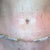 2 days post-op Revision