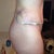 2 days post-op Revision