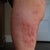 left lateral thigh, 2 days post procedure