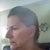 11-18-2011 10 months after surgery