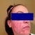 Note the white streaks you get because they work in sections. You can kind of see the extra-red spots from subcision.No makeup.
