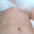 This is a pic of my tummy tuck cut 5 days post op. I love the incision cuz its thin and low to my pubic area and a cute happy smile which will be well hidden in my bikini's. I luv my belly button as well. But the best part is that it looks like a natural tummy and not like my first tummy tuck which the skin looked supper streched.