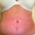 Three weeks PO. Can you see the slit under my bb?  Hate it!  Hope he can fix that for me!  Ugh.