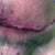 This was taken the last day of November 2010.  I had been having alot of abdomen congestion you can tell by the discoloration on my skin and all the blood vessels sticking up.  I was swollen.