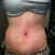 Week 2 Post-op.  Taken in the afternoon.    Puffy below the BB.