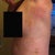 After - 3 days after procedure.  With my arm stretched up, the fat appears to be completely gone, but there is some that stayed behind