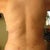 Back - after procedure.