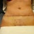 Day 9 PO dressings re-dressed....old tan lines now showing as being pulled downwards plus my 2 freckles that were either side of my tummy bottom are now just a tad above my cut line