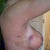 The worst of my bruising.
