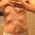 Right before surgery. You can see where the shell is poking me all the time. It's as comfortable as it looks;)