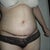 MY belly day 10!  My scar is very low.  My bb looks really tiny.  It will be interesting to see if it changes as it heals.