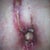 my belley buttin took a whioe to heal dr alswo aske i keep in for 2 weeks longer