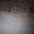 i had 2 spots above pelvic are that took a whie to heal now everyone kept saying put neosporin on it well you know what helpd me sleeping with out garmet and leaving it dry