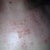 The day after the treatment