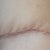 04/26/13-PO 3 WEEKS-left side scar