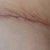 04/26/13-PO 3 WEEKS-right side scar