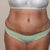 12 Days Post Op
