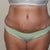 12 Days Post Op