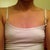 Shirt on front view day b4 surgery