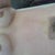 This shows my incision and bruising. My stomach barely hurt at all at first, but is tender to the touch now.