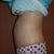 4 weeks post op side view, still have the large hematoma sticking out (PS said to expect it to lessen over the next 3 months)