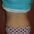 4 weeks post op back view, cannot believe how good my butt looks now!  It is more shapely as a side effect of the circumferential TT
