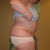 7 days post op - still one drain in